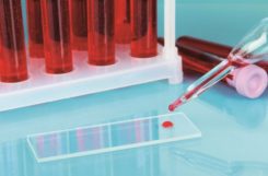 Нормальные показатели сахара и холестерина в крови Нормальные показатели сахара и холестерина в крови